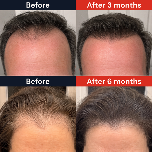 Receding Hairline