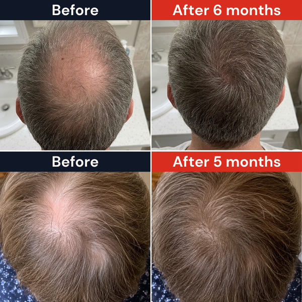 Bald Spots