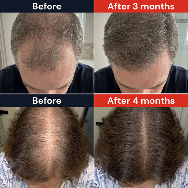 Hair Thinning