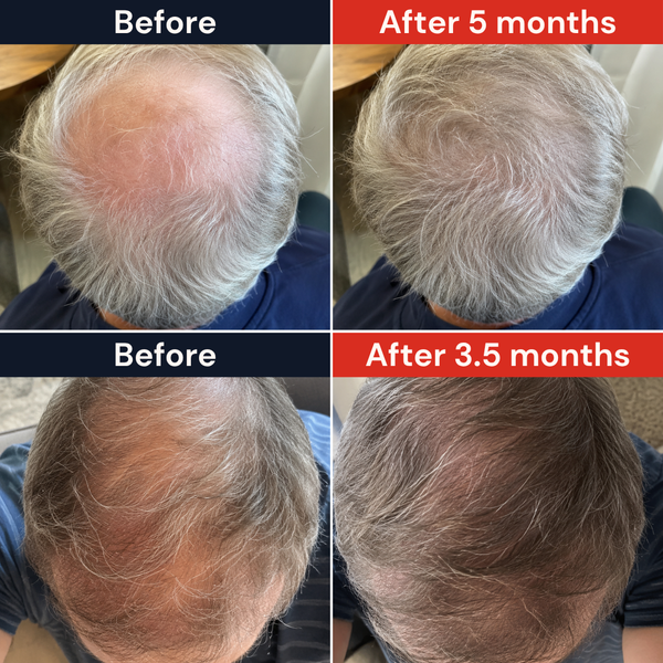 Hair Loss