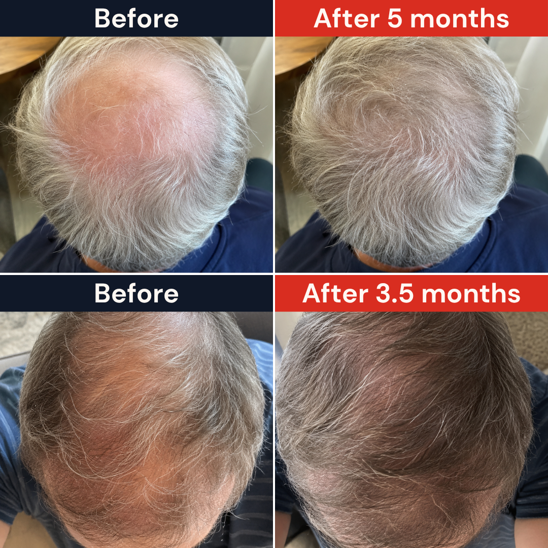 FAMGOES Core 94 Laser Cap / Early Thinning Support