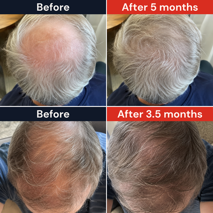 FAMGOES Core 94 Laser Cap / Early Thinning Support