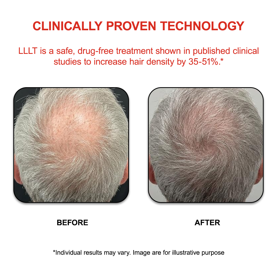 FAMGOES Plus 128 Laser Cap / Enhanced Scalp Coverage